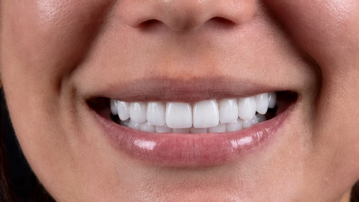 Hollywood Smile Tunisie — Après 18 facettes E-Max IPS Ivoclar