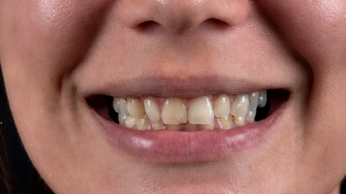 Hollywood Smile Tunisie — Avant traitement facettes E-Max
