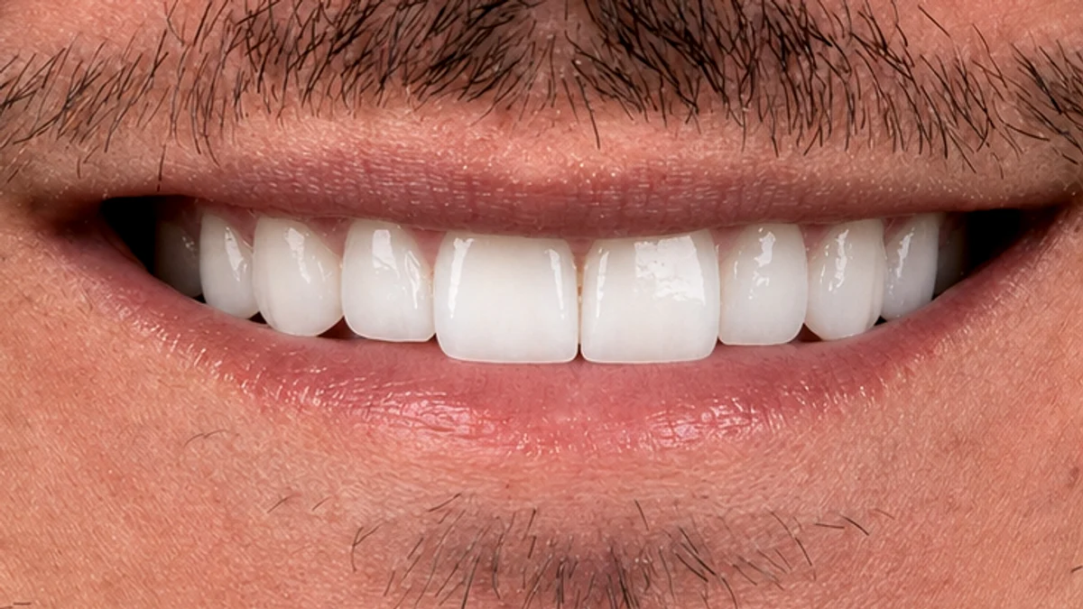 Après facettes E-Max IPS e.max® Tunisie — dents blanches alignées